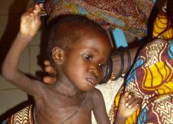 Am schwersten trifft die Hungersnot die Schwächsten. Unzählige Kinder in Niger leiden an Unterernährung. Foto: humedica