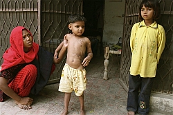 Josephine überlebte die schlimmen Verbrennungen, obwohl sie erst nach vier Tagen behandelt wurde. Foto: humedica/Nils Stilke
