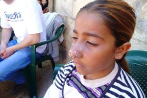 Leishmaniose, auch Bagdad-, Orient- oder Aleppobeule genannt, sorgt zu Hautinfektionen wie an der Nase bei dieser Patientin. Foto: humedica/Elke Göhre