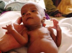 Zeinabou im Oktober 2009, nachdem das Team der humedica-Klinik die Kleine bereits etwas aufgepeppelt hatte. Foto: humedica/Simone Winneg